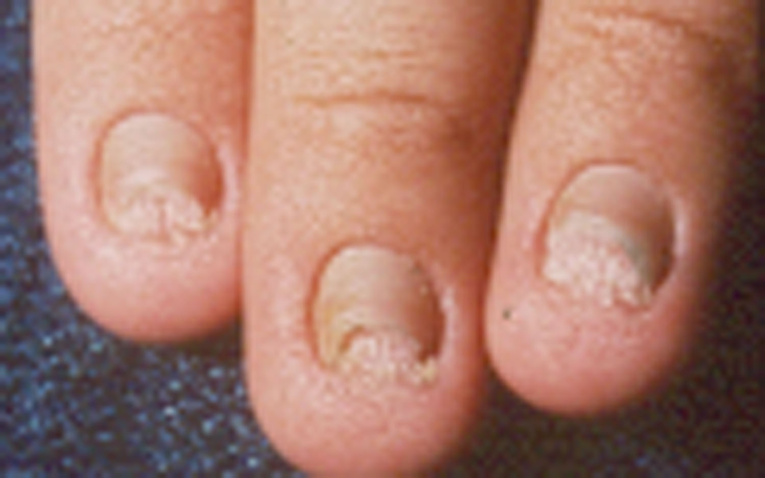 Ectodermal Dysplasias How Nails Can Be Affected Nfed 6621