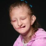 Girl affected by Goltz syndrome