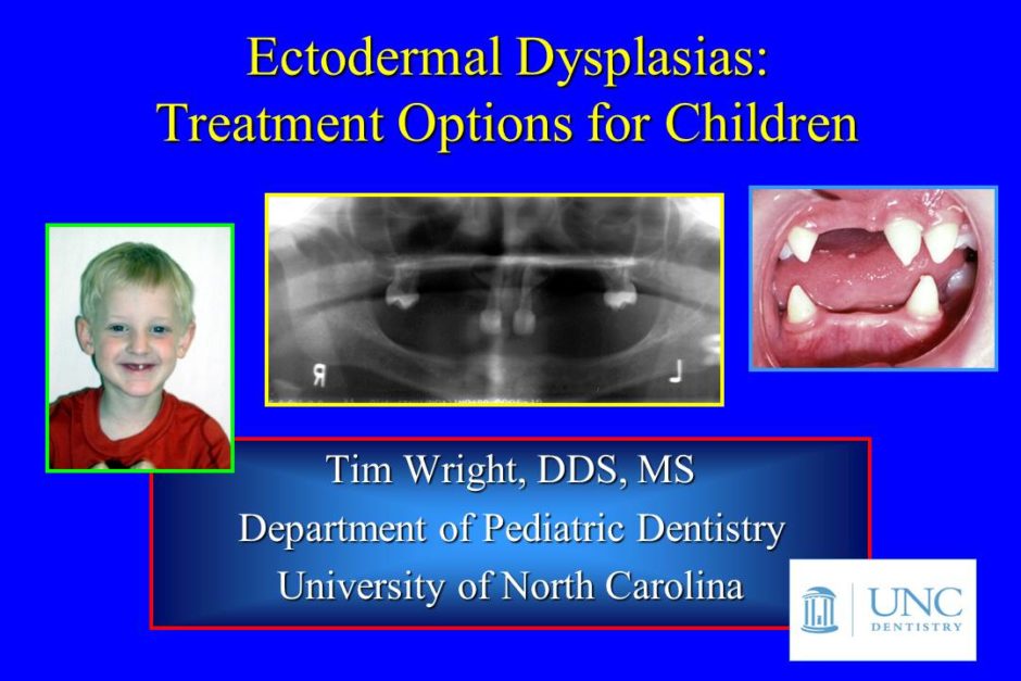 Ectodermal Dysplasia Treatment Videos Now Available - NFED
