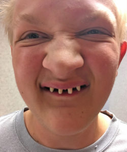 Mason without caps on his front teeth.