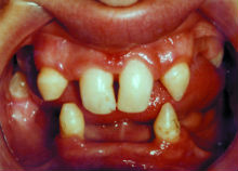 Abnormal Teeth Shape