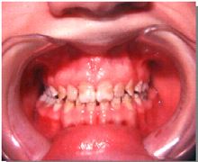 Teeth with Bad Enamel