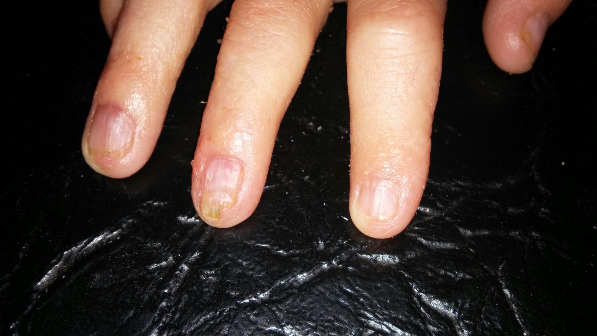 Nail Abnormalities Ectodermal Dysplasias Symptoms NFED