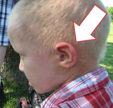 A boy with AEC syndrome has a profile shot. His ear is red because he's overheated from his sweat glands not working.