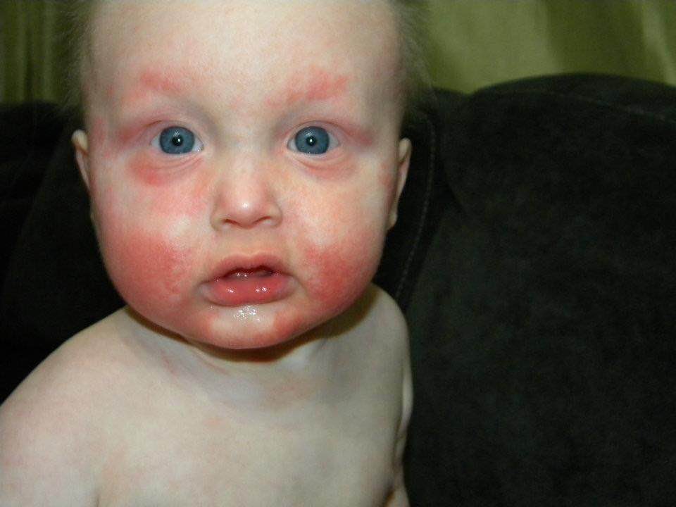 Ectodermal Dysplasias Skin Symptoms | NFED