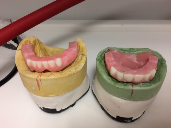 First Dentures for Hazel Her Mom's Perspective NFED