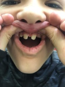 Isaiah shows off his top teeth by pulling up his top lip.