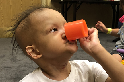 Boy with XLHED drinking out of a toy cup.