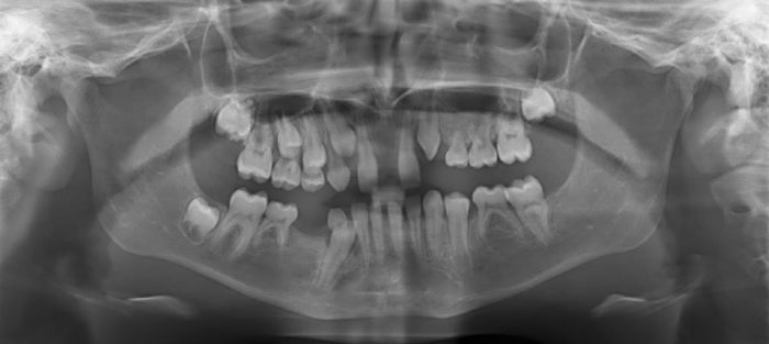 incontinentia pigmenti teeth issues