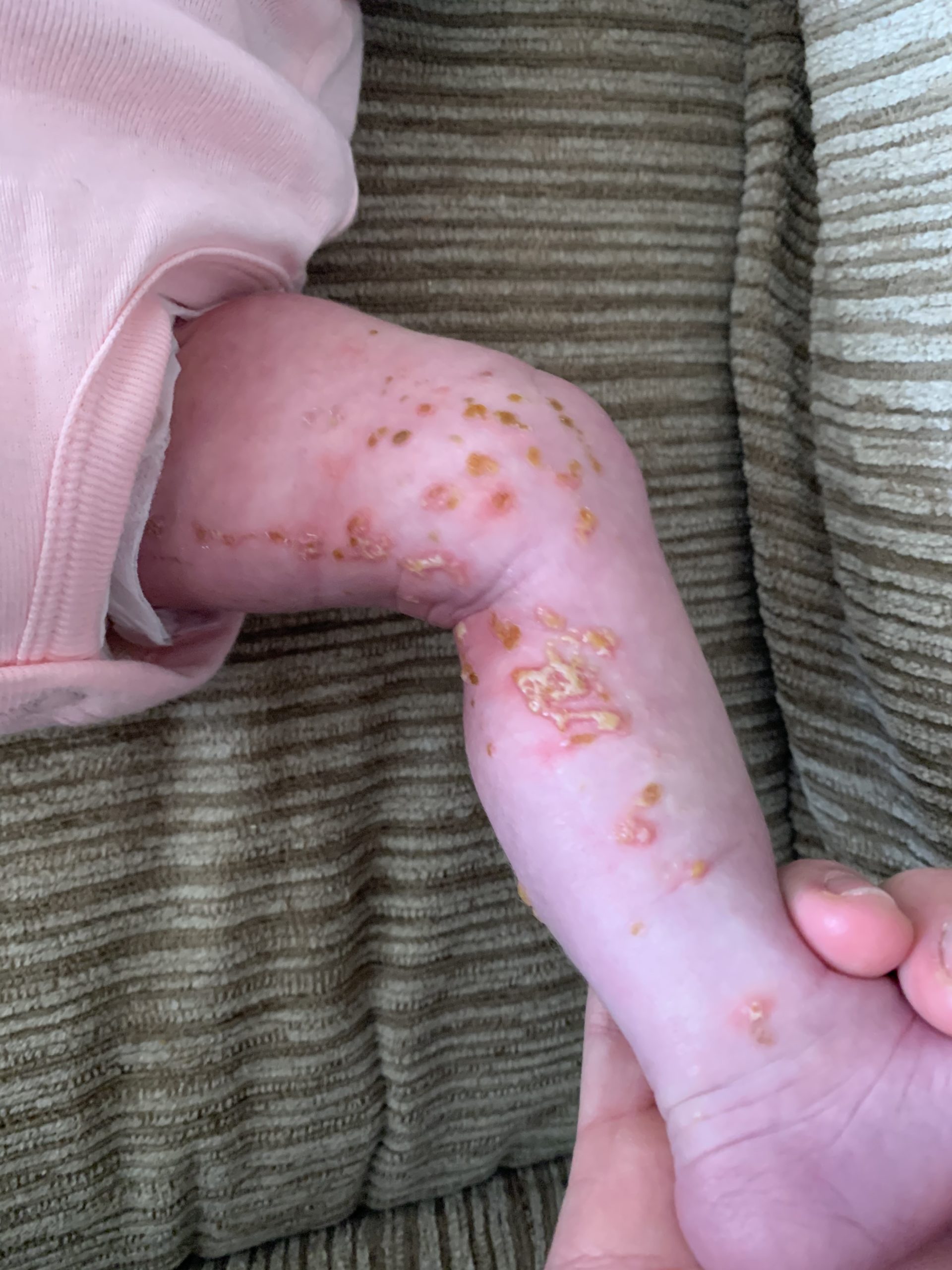 Research Conference Seeks Answers for Incontinentia Pigmenti