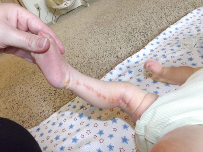 Mom holds the foot of an infant to show a red rash that was down the back of the leg.