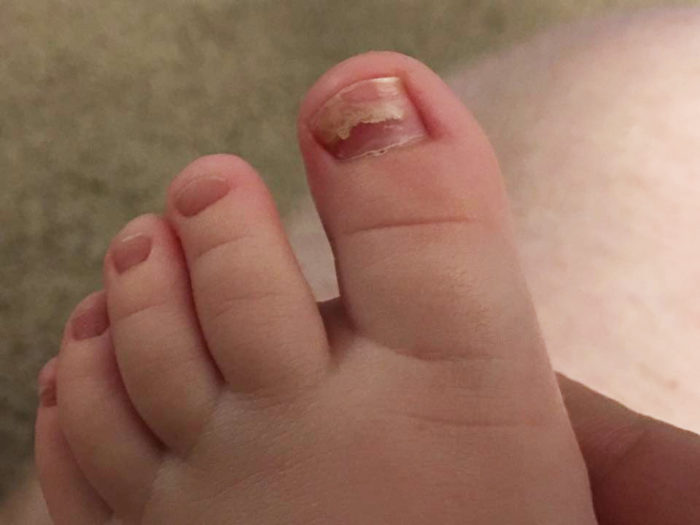 Photo of Jamistyn's foot. The nail on the big toe is pitted, discolored from incontinentia pigmenti.