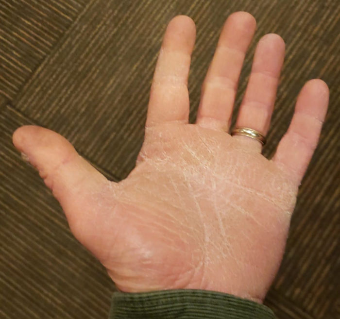 A hand is shown palm up with a wedding ring on one finger. The  skin is affected by palmoplantar keratosis.