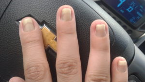 Clouston nails