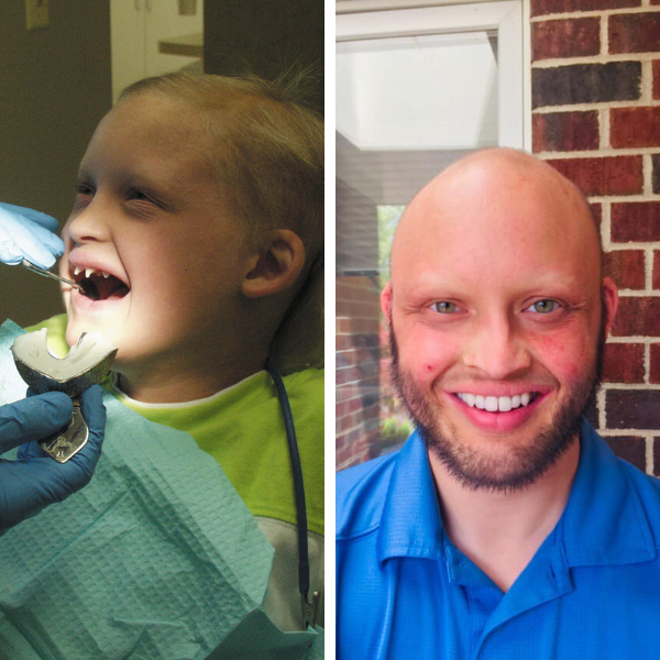 The before picture shows a young Carver at the dentist opening his mouth. He has just a few teeth which are pointed. The after picture shows Carver as an adult with his dentures and dental implants.