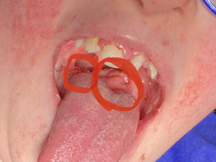 Papillomas shown in the back of the throat.