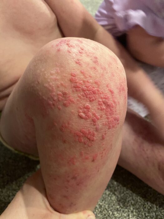 multiple red papillomas on the knee