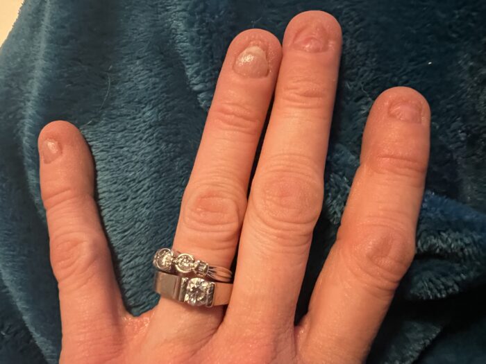 A picture of a woman's hand. It has two diamond rings on the ring finger. The photo shows nail abnormalities caused by Clouston syndrome. The nails are small and almost missing.