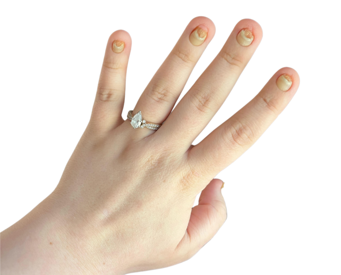 This is a picture of a woman's hand. She's wearing a diamond ring. The photo illustrates fingernails that are pitted, small and discolored.