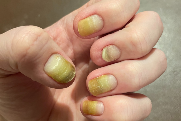 The pictures shows fingernails affected by Clouston syndrome. They are discolored and have white spots.