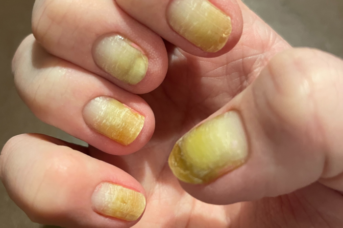 The pictures shows fingernails affected by Clouston syndrome. They are discolored and have white spots.