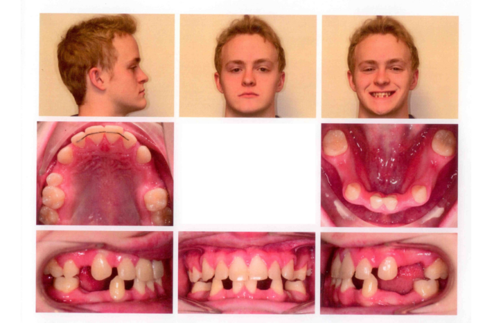 Three photos of an 18-year-old showing his profile and his missing teeth. Give intra-oral photos showing his missing teeth.