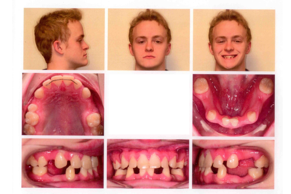 Born Without Teeth From Resentment To Empowerment NFED