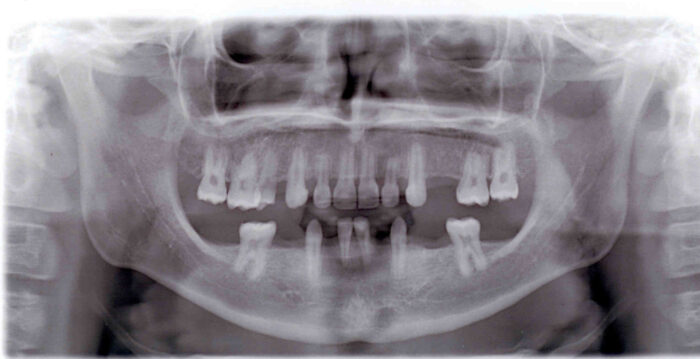 This is a panorex of Soren's mouth and shows that he is missing many teeth in his lower jaw and several in his upper jaw.