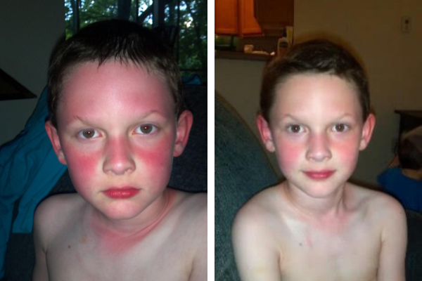This is a collage of side by side photos of a young boy. At left, the boy has a very red face, forehead and lips because he's overheated. At right, his face is pink because he's cooling down.
