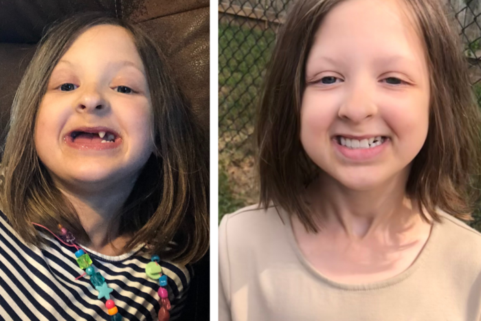 This is a side by side photo of a girl with medium length brown hair. The left picture shows she's smiling without her dentures. She has just a a few teeth and one is conical shape. In the right picture, she's wearing her dentures.