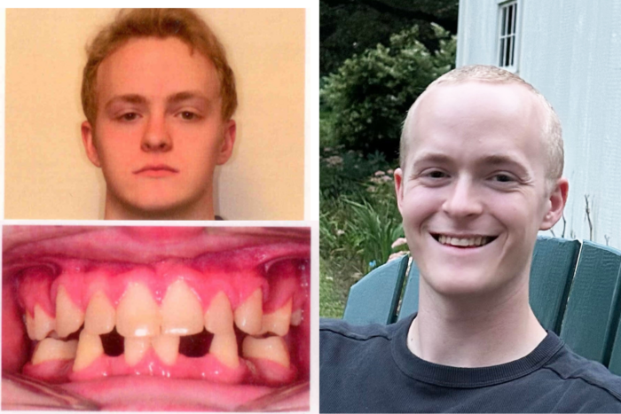 This is a collage of three photos. One shows a young adult not smiling. The lower left photos shows a picture of the young man's teeth before treatment. He's missing many teeth on the bottom and many are misshapen. The picture on the right shows the young man smiling with a full set of teeth.