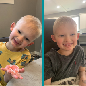 These are side by side images of a small boy with blonde, sparse hair. In the first photo, he's holding his set of dentures in his hand. In the second photos, he's smiling with the dentures in his mouth.