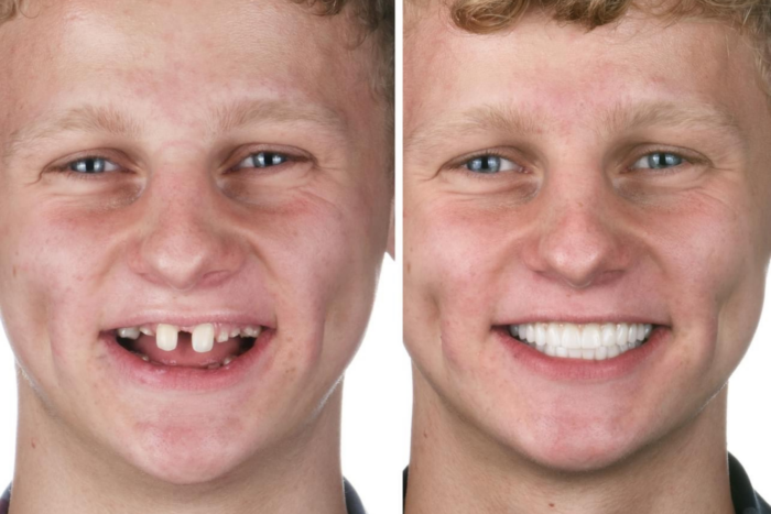 These side by side photos show a teenage boy affected by ectodermal dysplasia with many missing and small teeth in one photo a complete set of teeth in the second photo. 