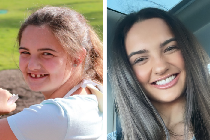 This is a collage of side by side photos. The left photos show a junior high age girl smiling with several missing teeth caused by ectodermal dysplasia. That same girl is pictured right now as a young woman. She has a full set of teeth. 
