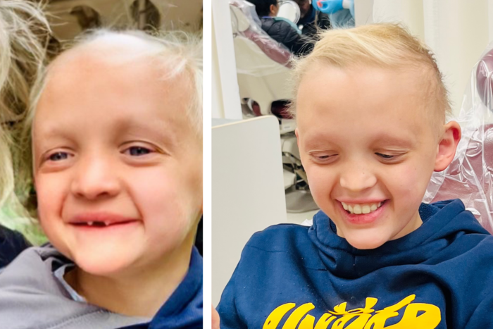 A young boy in side by side photos which depict him with and without dentures. In the one without, he has just two teeth, due to ectodermal dysplasia.