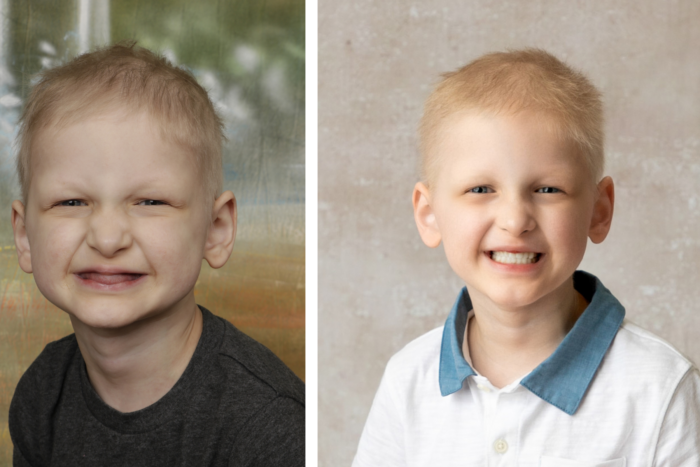 This is a side by side photo. In the left photo, the pre-schooler doesn't appear to have any teeth. In the right photo, he's smiling with a full set of dentures in his mouth.