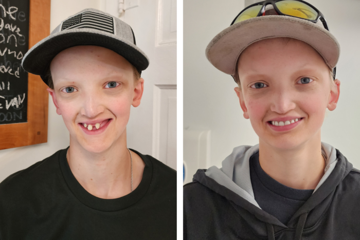 This side by side photo shows a teenage boy wearing a baseball hat. In the photo at left, he only has three teeth and they are misshapen from ectodermal dysplasia. On the right, he's wearing a full set of dentures.