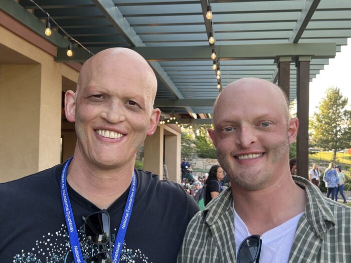 Two men affected by ectodermal dysplasia who are bald stand side by side.