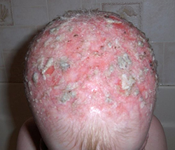 This photo shows the top of a toddler's head who has AEC syndrome. The scalp is pink/red and there are numerous areas all over the scalp that are scabs from where there was skin erosion. The skin looks very goopy from products applied to moisturize it and keep infection free.