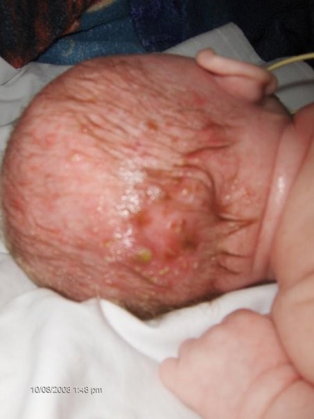 This is a photo of the back of an infant's head. The skin is pink where the skin has sloughed off an is missing. There are erosions that look puss filled.