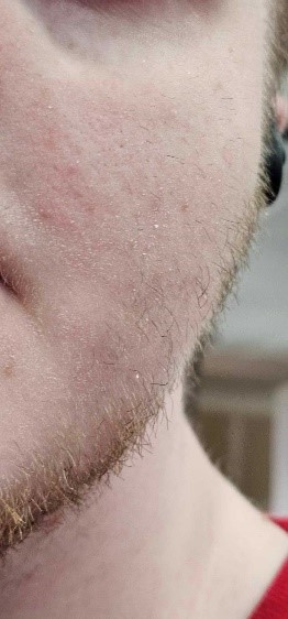 This is a close up photo of a teenage boy's face, showing his facial hair. The boy is affected by AEC syndrome.