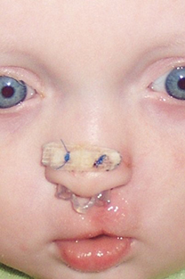 A baby with blue eyes has a device in his nose to shape his nose after a cleft lip repair. There is a white strip on the ti of his nose which is a nasal shaper.