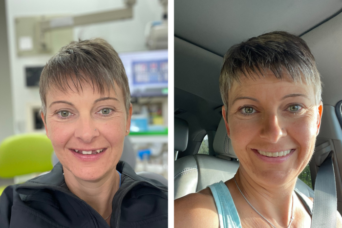 Amanda shows off her before and after smile.