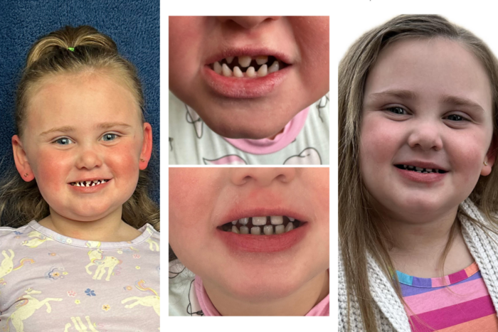 Four photos showing a young girl's teeth before and after she got crowns to reshape her teeth to a normal size.