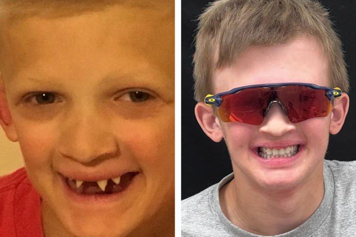 A side by side photo of a boy with only a few pointy teeth and then his new denture.