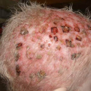 This is a close-up of a calm with a little hair and numerous skin erosions in various states of healing.