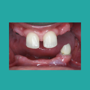 This is an intra-oral photo showing a mouth with 2 front teeth on the top and one tooth on the bottom.
