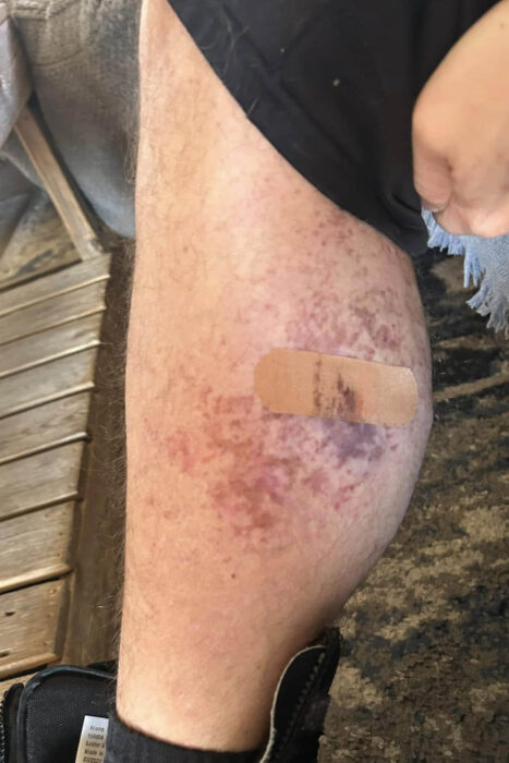 This is a photo of a man's calf. It has skin lesions on it from Goltz syndrome and a Band-Aid. 