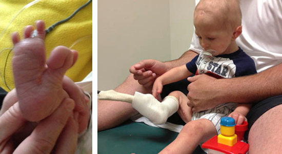This is a side by side photo. The photo at left is of a baby foot that is missing one toe and the big toe curls under. The photo at right is the baby sitting with a parent. He has his foot bandaged where he had surgery on the toe.