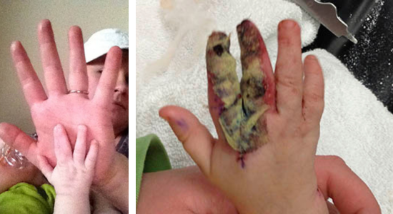 This is a side by side photo. The left photo shows a baby's hand up against his mom's hand. The baby has two fingers fused together. The photo on the right is the baby's hand after surgery. You can see the fused fingers are now separate and have a bandage on them.